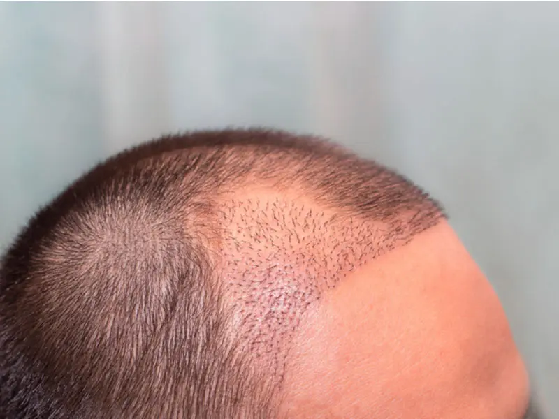 Scarless Follicular Hair Transplant